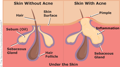 New Research: Acne is Caused by Inflammation