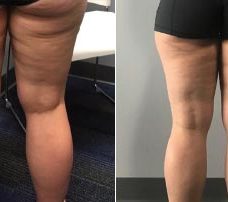 cellulite-one-treatment
