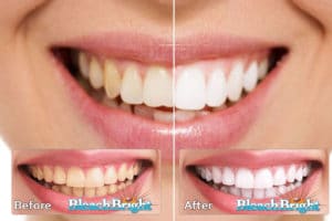 Bleach Bright Teeth whitening Before And After Photo
