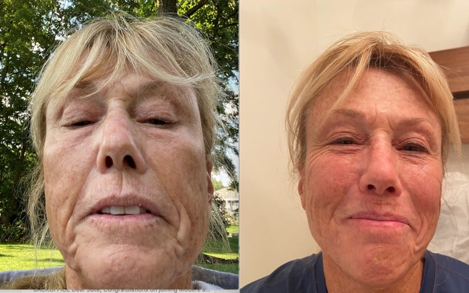 Before And After photo of Bioptron Treatment