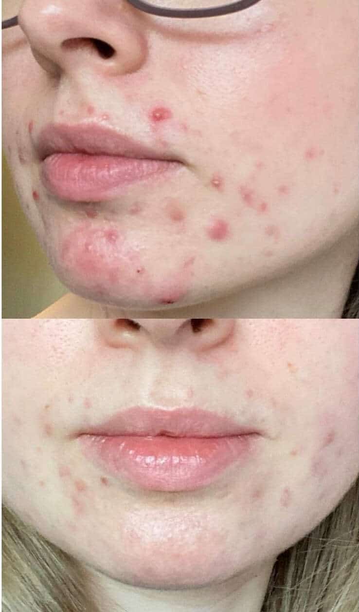 Before And After Photo of Bioptron Treatment in Cincinnati