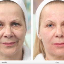 Before And After Photo Of Treatment