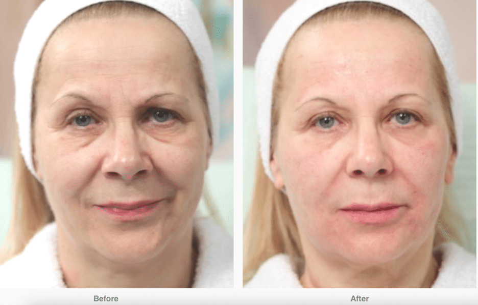 Before And After Photo of Bioptron Light Treatment