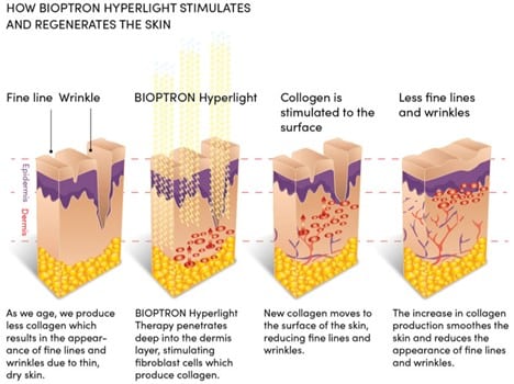 How Bioptron Hyperlight Stimulates And Regenerates The Skin