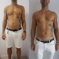 Before And After Cryotherapy Treatment Photo