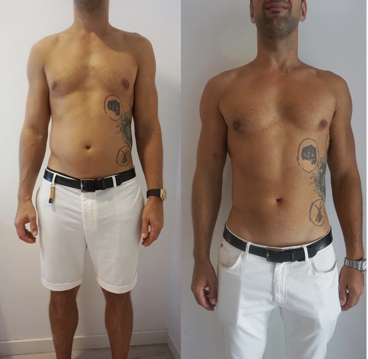 Before And After Cryotherapy Treatment Photo