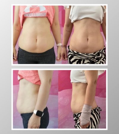 Before And After Photo Of Fat Reduction
