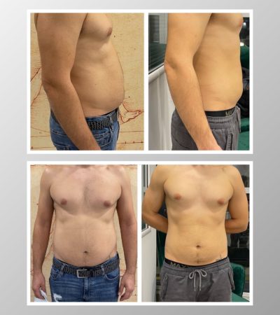 Before And After Photo Of Fat Reduction