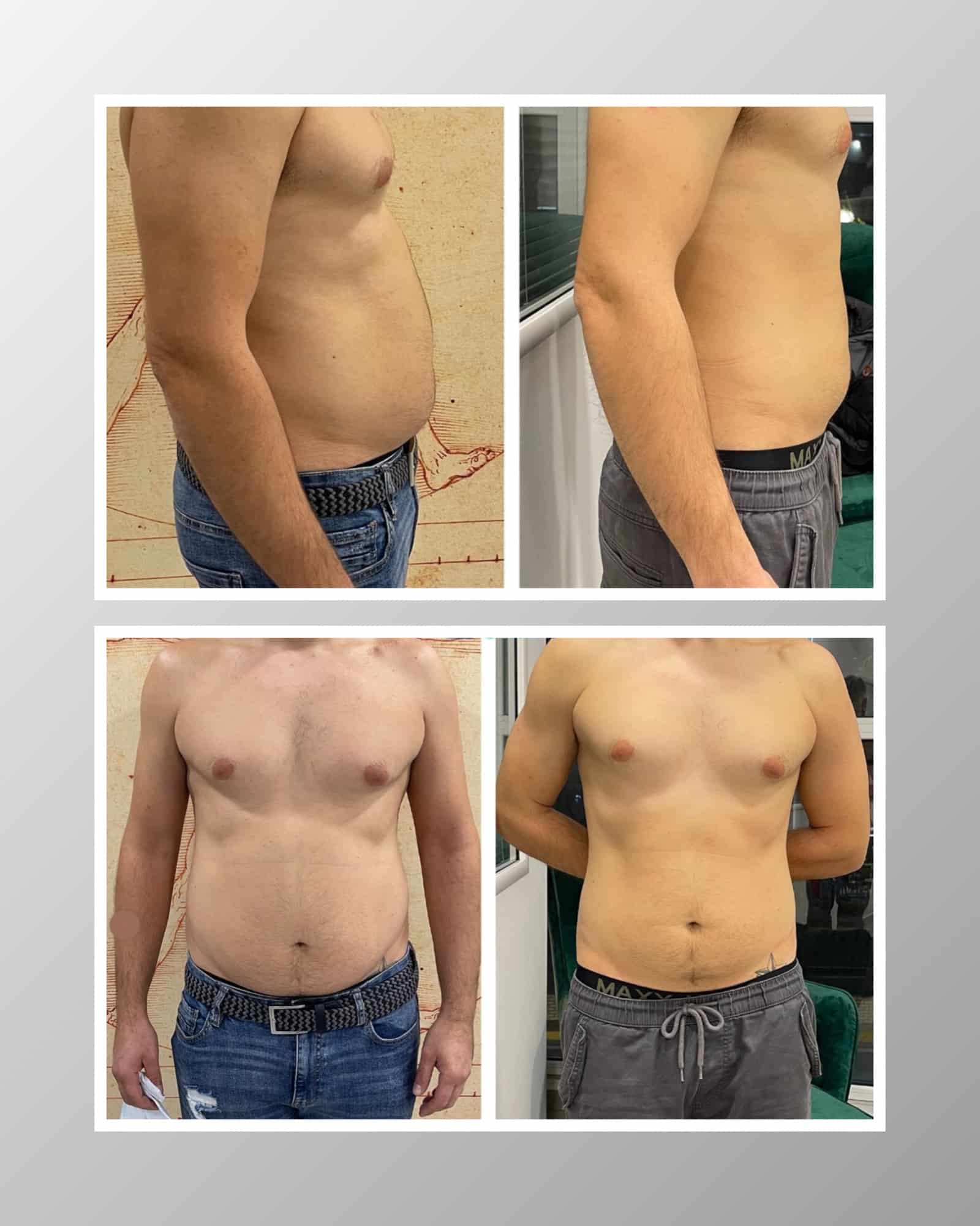 Before And After Photo Of Fat Reduction