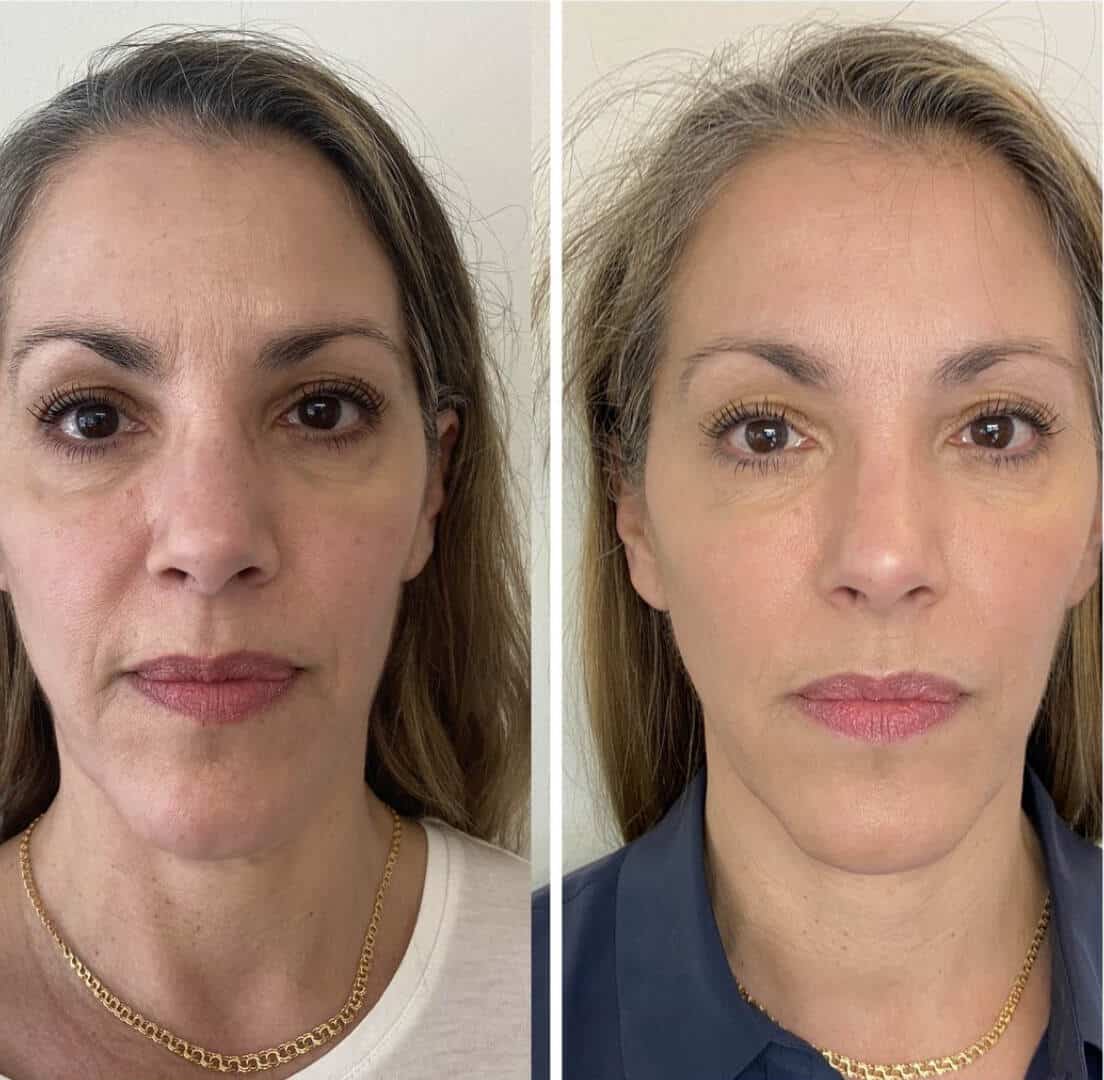 Before and After 4 PRX-t33 Treatments Image