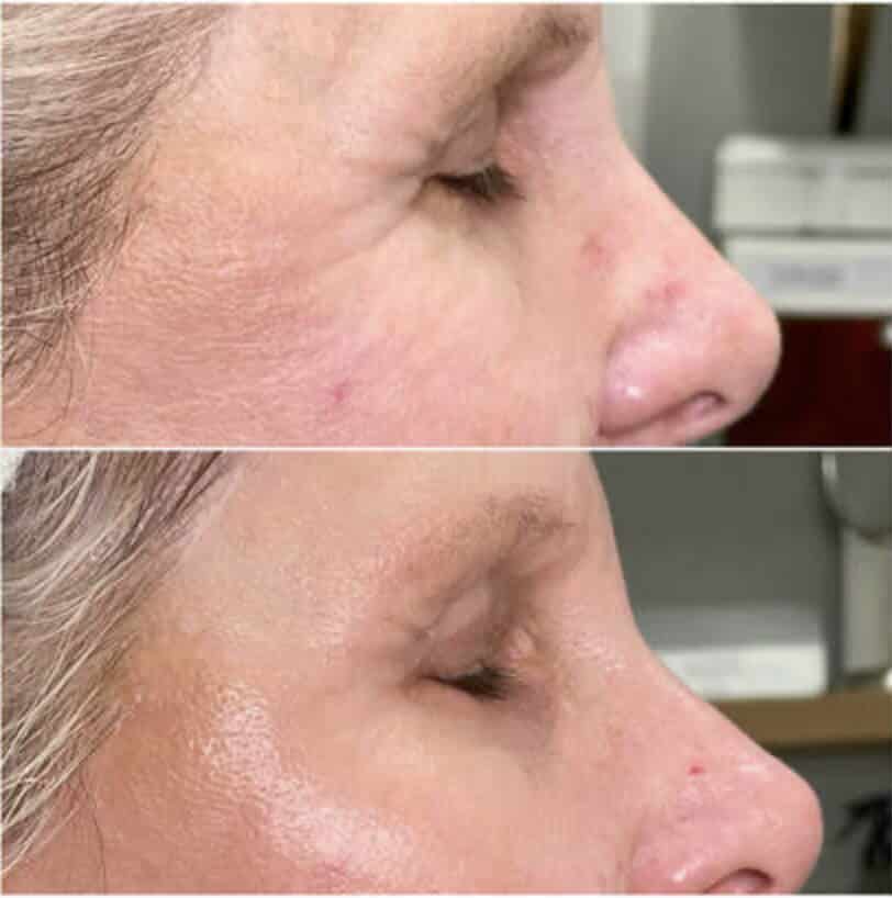 Before and After 2 PRX-t33 Treatments Photo