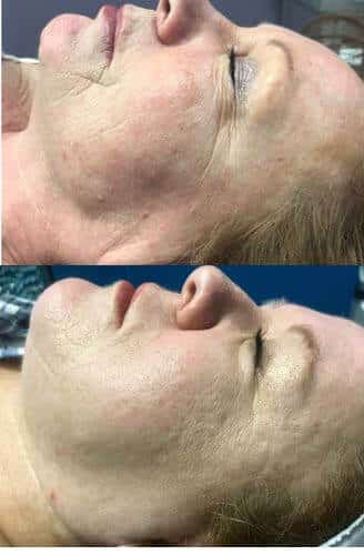 Before and After 4 PRX-t33 Treatment Photo