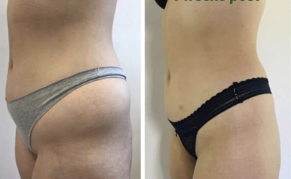 before after body 4 weeks amazing
